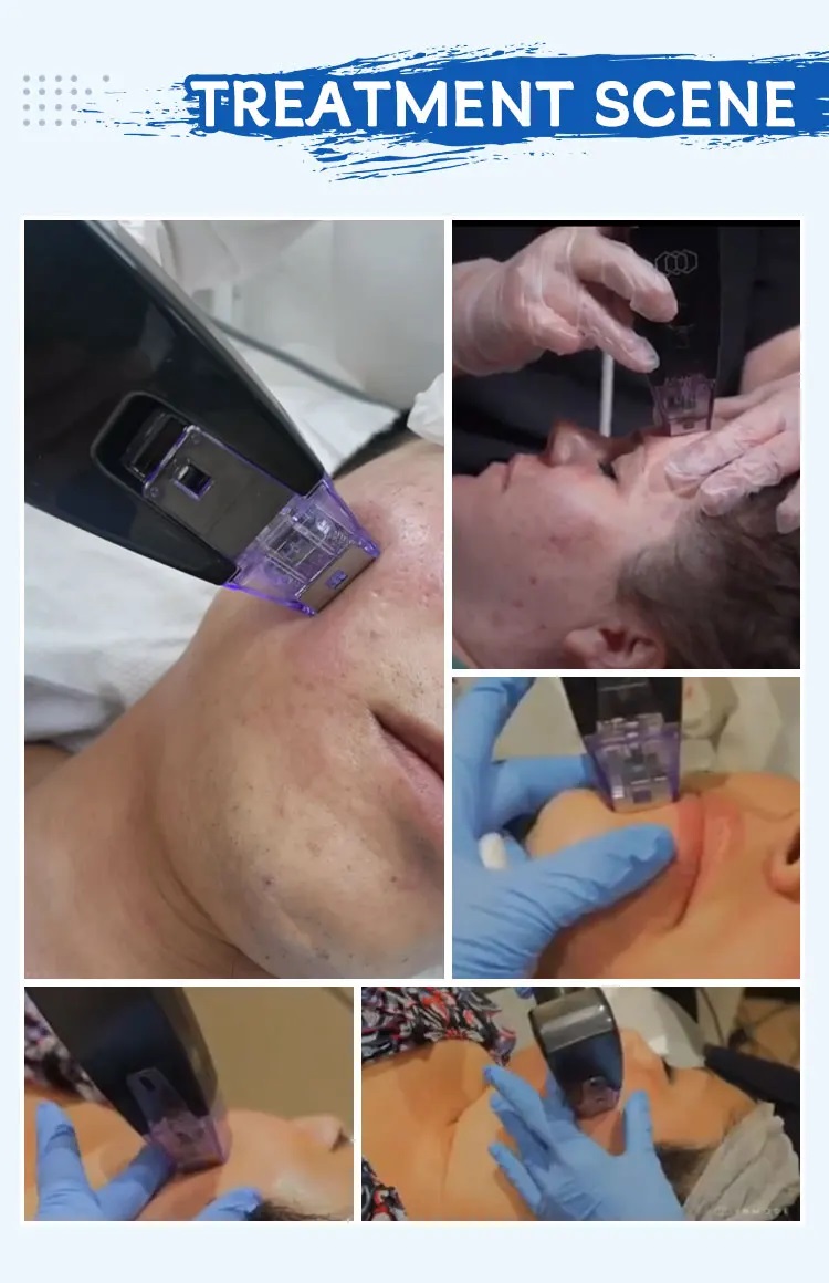 new fractional microneedling rf machine 7.jpg